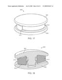 Intervertebral Prosthetic Disc With Shock Absorbing Core Formed With Disc Springs diagram and image