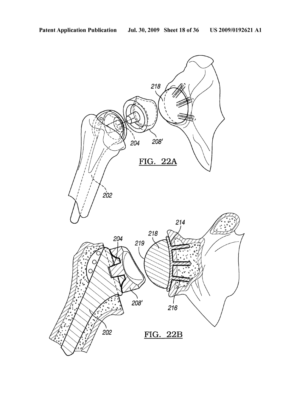 Shoulder Implant Assembly - diagram, schematic, and image 19