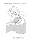 Clip Device and Laryngeal Mask Airway diagram and image