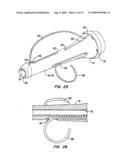 Tissue Separating Catheter Assembly and Method diagram and image