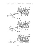 FRONTAL SINUS SPACER diagram and image