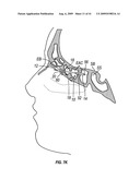 FRONTAL SINUS SPACER diagram and image