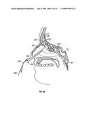 FRONTAL SINUS SPACER diagram and image