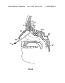 FRONTAL SINUS SPACER diagram and image