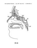 FRONTAL SINUS SPACER diagram and image
