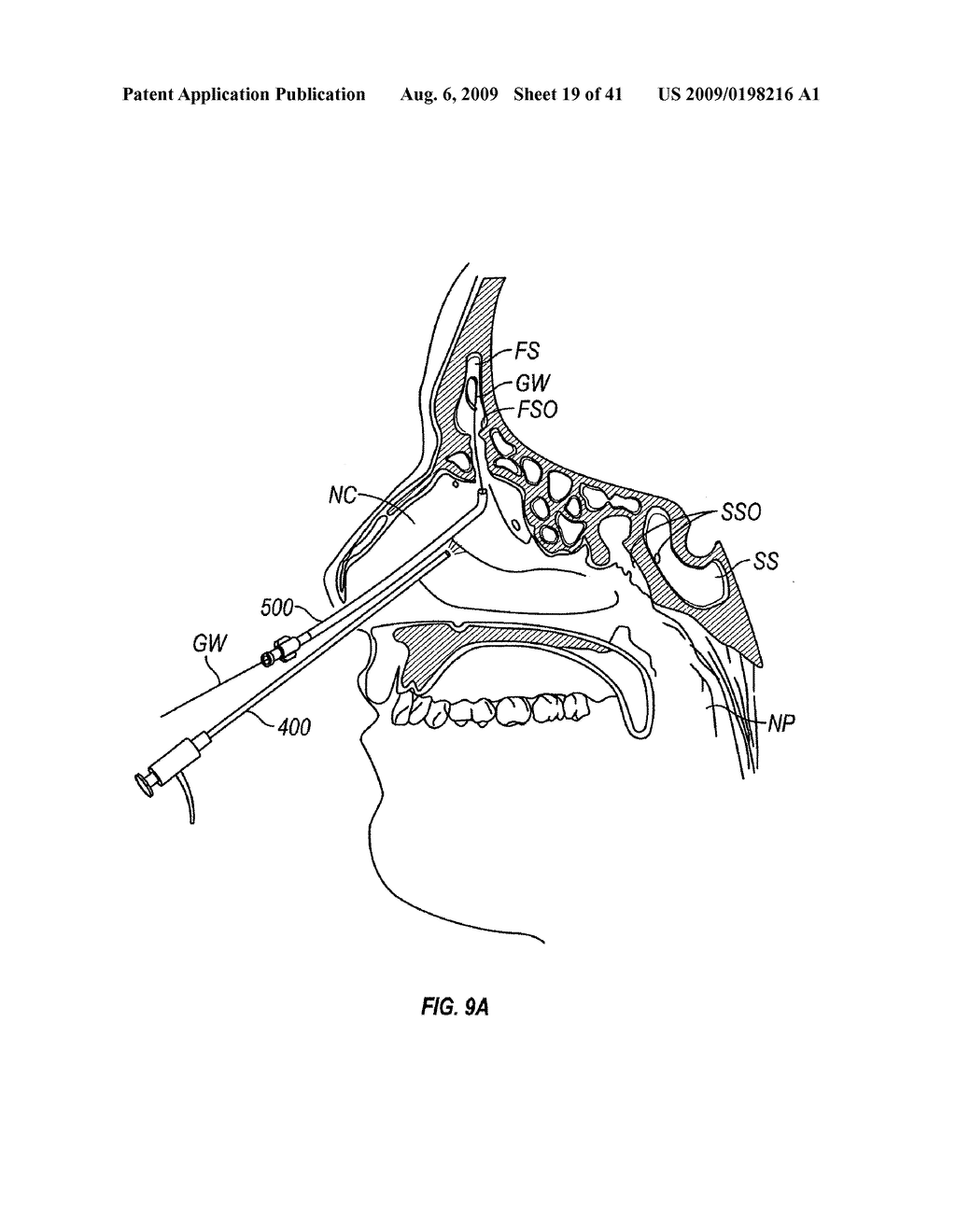 FRONTAL SINUS SPACER - diagram, schematic, and image 20