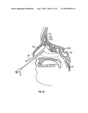 FRONTAL SINUS SPACER diagram and image