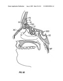 FRONTAL SINUS SPACER diagram and image