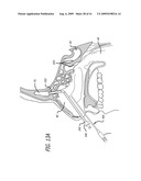 FRONTAL SINUS SPACER diagram and image