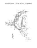 FRONTAL SINUS SPACER diagram and image