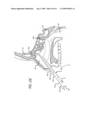 FRONTAL SINUS SPACER diagram and image