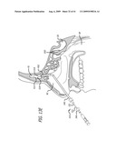 FRONTAL SINUS SPACER diagram and image