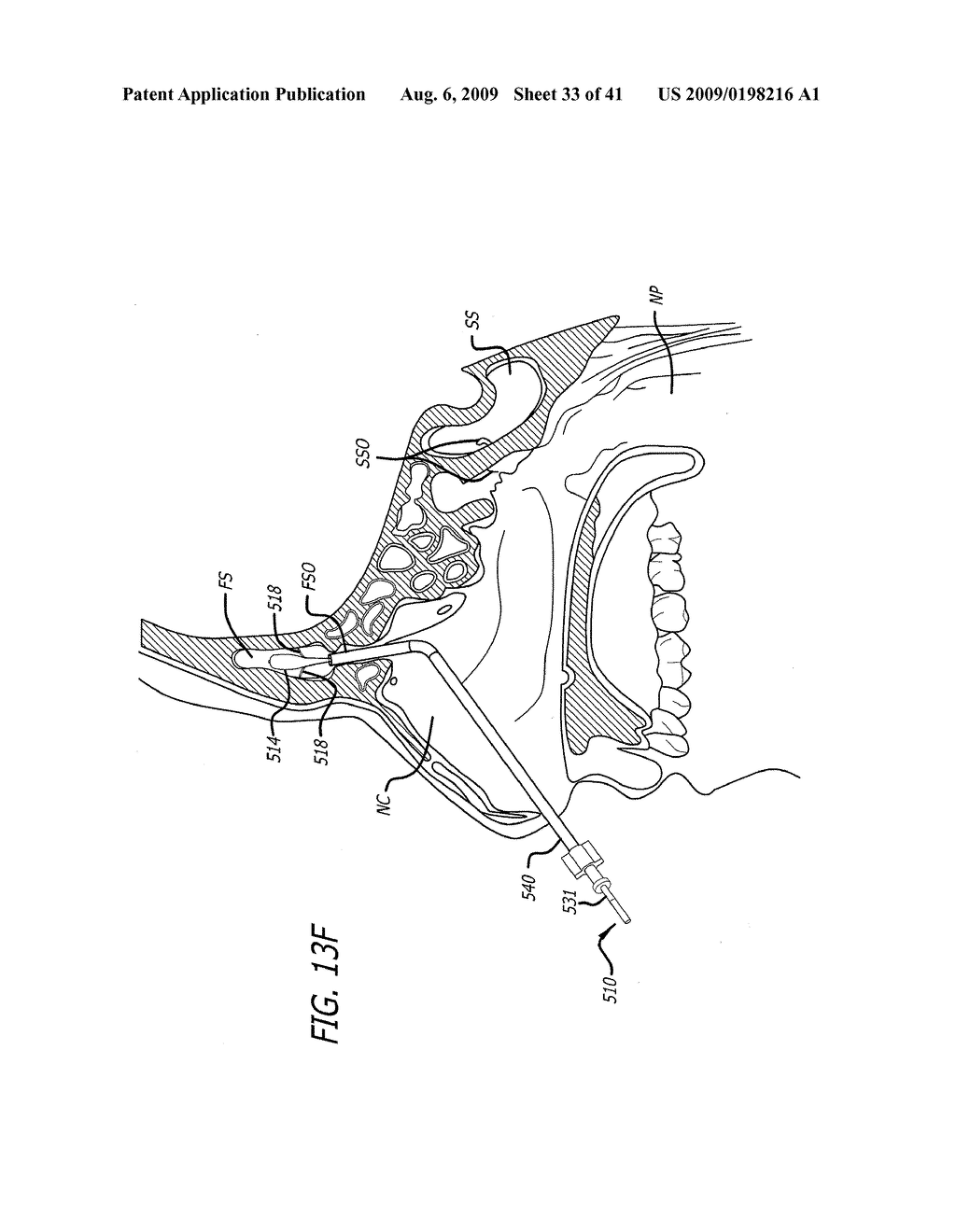 FRONTAL SINUS SPACER - diagram, schematic, and image 34