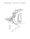 FRONTAL SINUS SPACER diagram and image