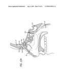 FRONTAL SINUS SPACER diagram and image