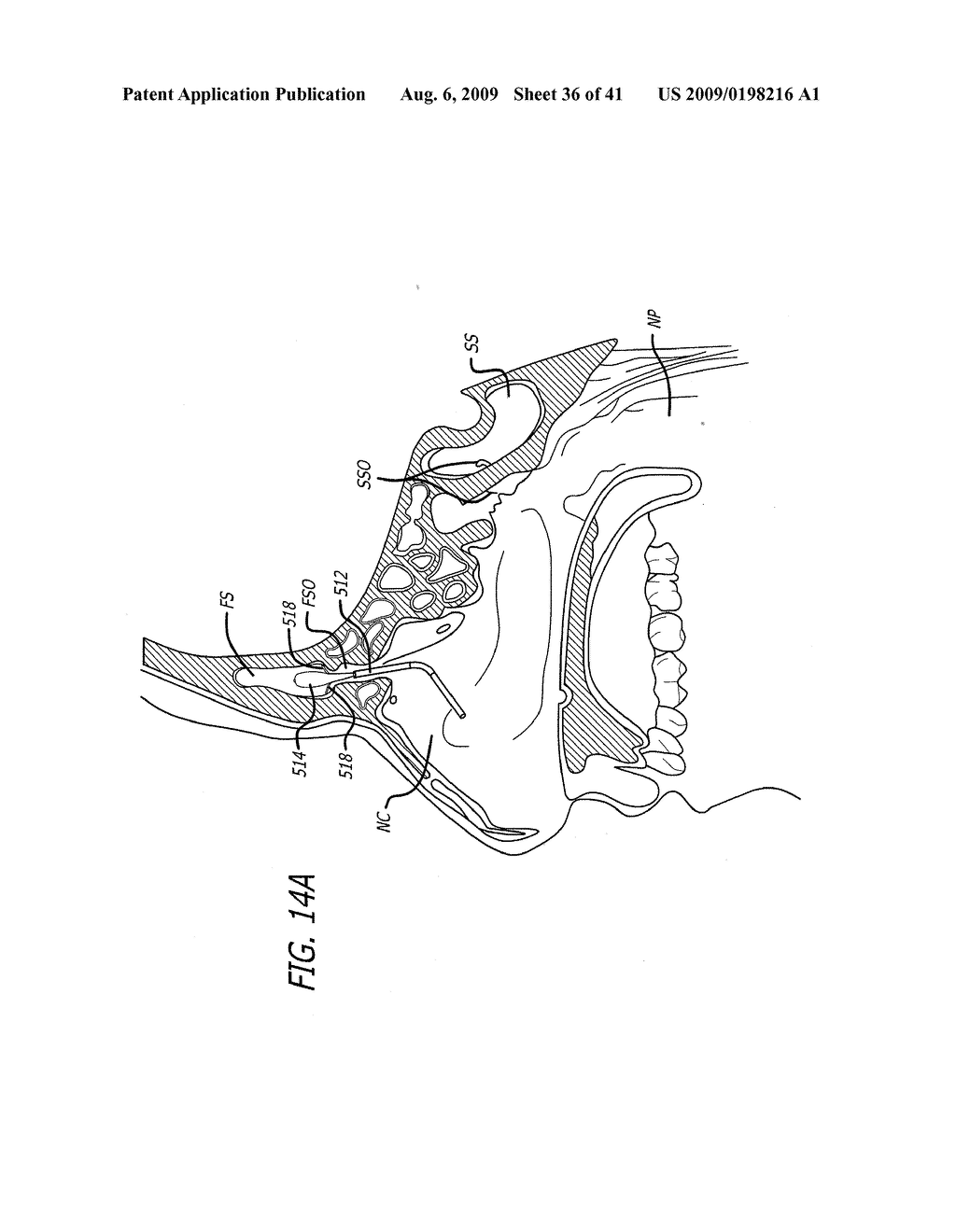 FRONTAL SINUS SPACER - diagram, schematic, and image 37