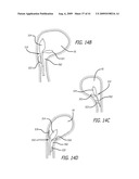 FRONTAL SINUS SPACER diagram and image