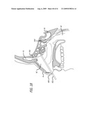 FRONTAL SINUS SPACER diagram and image