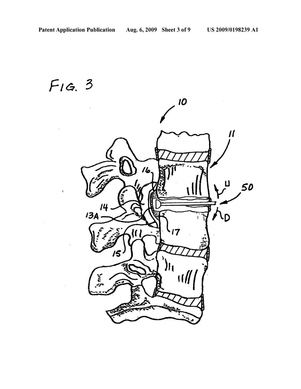 Apparatus and procedure for anterior cervical microdiskectomy - diagram, schematic, and image 04