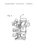 Apparatus and procedure for anterior cervical microdiskectomy diagram and image