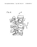 Apparatus and procedure for anterior cervical microdiskectomy diagram and image