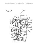 Apparatus and procedure for anterior cervical microdiskectomy diagram and image