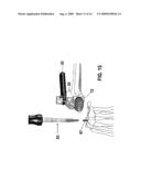 Instrument for Implanting a Wrist Prosthesis diagram and image
