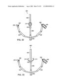 Methods and Devices for Tissue Reconfiguration diagram and image