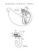 Methods and Devices for Tissue Reconfiguration diagram and image