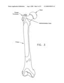 METHOD AND APPARATUS FOR RE-ATTACHING THE LABRUM OF A HIP JOINT diagram and image