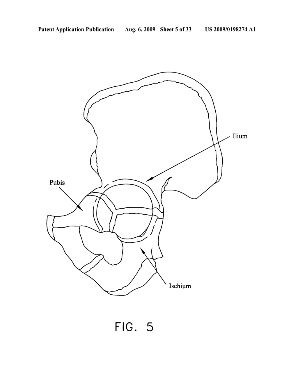 METHOD AND APPARATUS FOR RE-ATTACHING THE LABRUM OF A HIP JOINT - diagram, schematic, and image 06