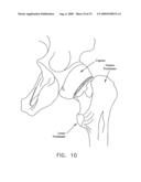 METHOD AND APPARATUS FOR RE-ATTACHING THE LABRUM OF A HIP JOINT diagram and image