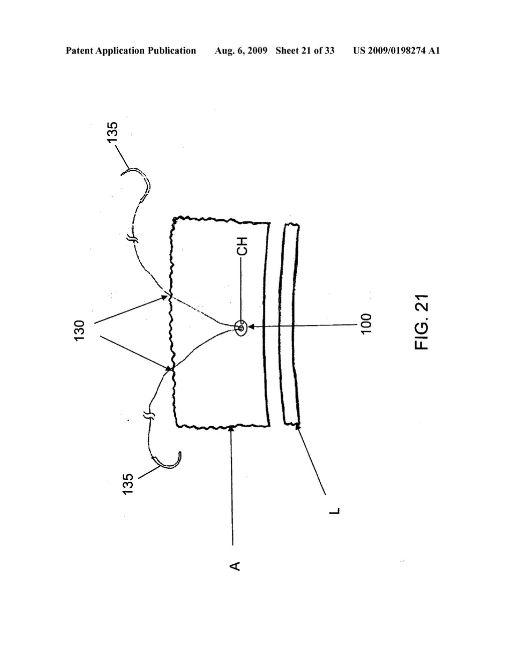 METHOD AND APPARATUS FOR RE-ATTACHING THE LABRUM OF A HIP JOINT - diagram, schematic, and image 22
