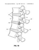 SPINAL IMPLANT AND METHOD FOR RESTRICTING SPINAL FLEXION diagram and image