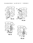 SPINAL IMPLANT AND METHOD FOR RESTRICTING SPINAL FLEXION diagram and image