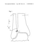 BONE FIXATION DEVICE AND METHOD OF USE THEREOF diagram and image