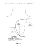 METHOD AND APPARATUS FOR OPTIMIZING VENTRICULAR SYNCHRONY DURING DDD RESYNCHRONIZATION THERAPY USING ADJUSTABLE ATRIO-VENTRICULAR DELAYS diagram and image