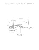 Automatic Capture Verification using Electrocardiograms Sensed from Multiple Implanted Electrodes diagram and image