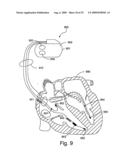 Automatic Capture Verification using Electrocardiograms Sensed from Multiple Implanted Electrodes diagram and image