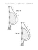 METHOD FOR TEXTURING THE SURFACE OF A SYNTHETIC IMPLANT diagram and image