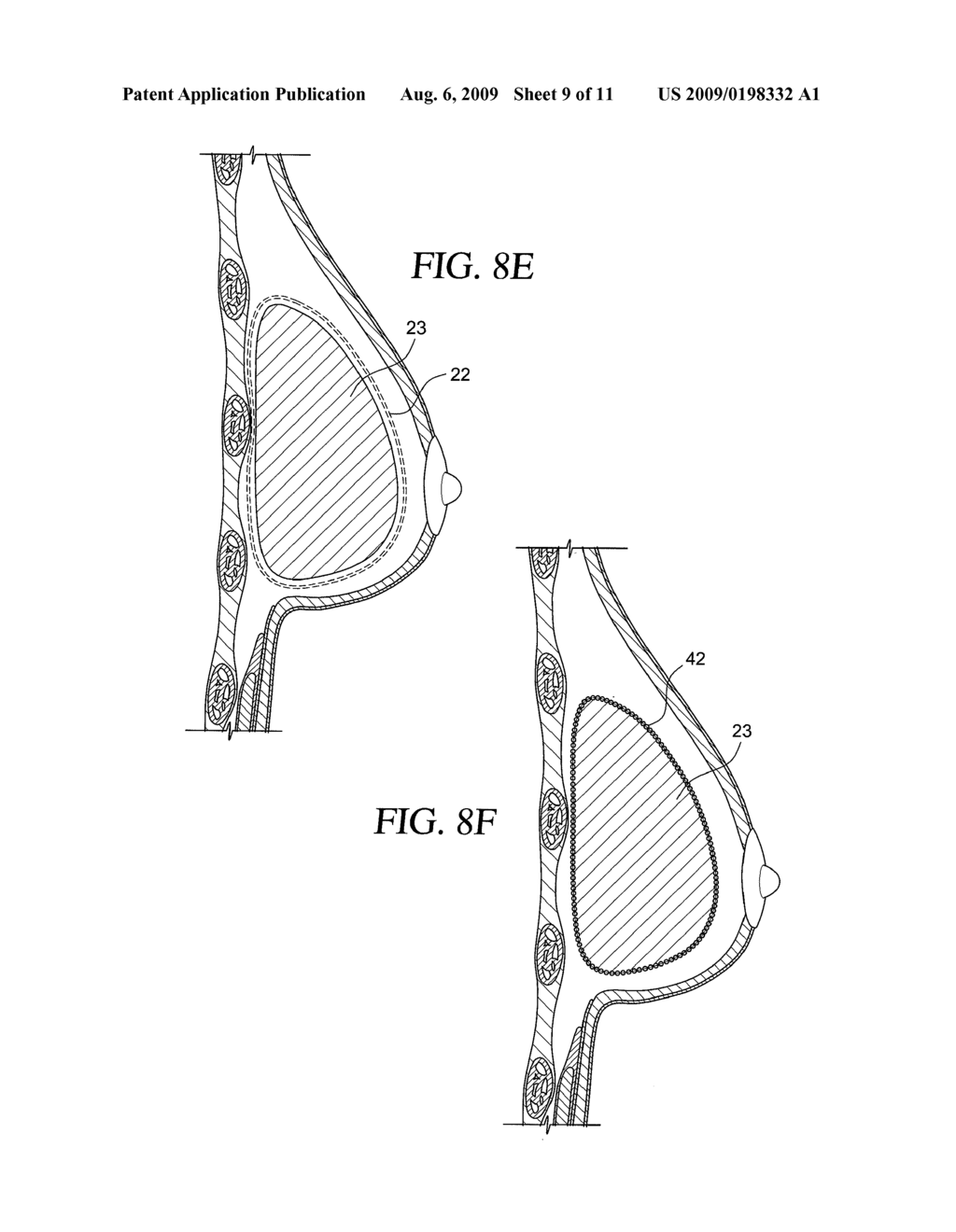 METHOD FOR TEXTURING THE SURFACE OF A SYNTHETIC IMPLANT - diagram, schematic, and image 10