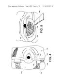 INFRA-ORBITAL IMPLANT diagram and image