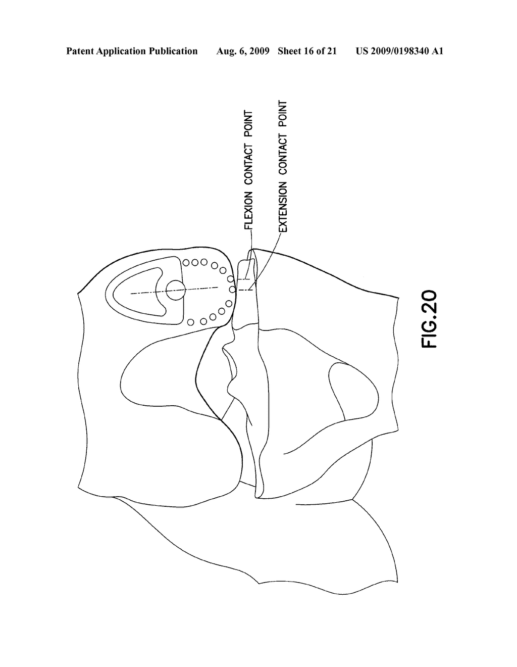 FEMORAL COMPONENT OF KNEE PROSTHESIS, THE FEMORAL COMPONENT HAVING ANTERIOR/POSTERIOR CLAW(S) FOR DIGGING INTO BONE AND/OR A RAISED RIB WITH A BULBOUS TERMINUS - diagram, schematic, and image 17