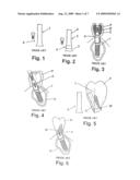 Dynamic Pillar for Correcting Incorrectly Positioned Implants and a Toll Therefor diagram and image