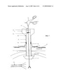 Two-part percutaneous endoscopic intragastric surgery cannula diagram and image