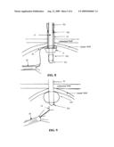 Two-part percutaneous endoscopic intragastric surgery cannula diagram and image