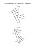 CATHETERS WITH ENLARGED ARTERIAL LUMENS diagram and image