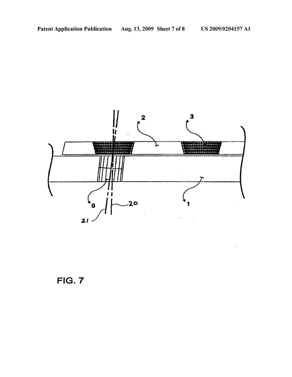 Locking Bone Plates with Controlled Locking Screw Misalignment - diagram, schematic, and image 08