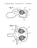 IMPLANT FOR STABILIZING VERTEBRAE OR BONES diagram and image