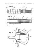 IMPLANT FOR STABILIZING VERTEBRAE OR BONES diagram and image